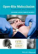 open-bite-malocclusion